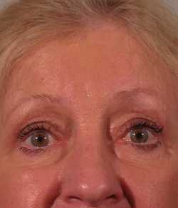 eyelid surgery fort myers