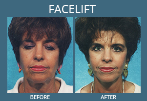 Botox Before and After Pictures Fort Myers, Cape Coral, FL